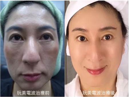 Oligio X超玩美電波案例照片，顯示治療前後的明顯改善效果，患者面部皮膚緊緻光滑，皺紋減少，整體膚質提升