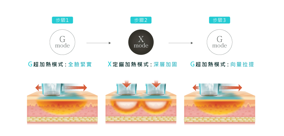 插圖展示GXG超玩美模式的治療過程，圖中以設備圖示和中文文字說明各步驟，背景為明亮診所環境，整體氛圍專業且安心