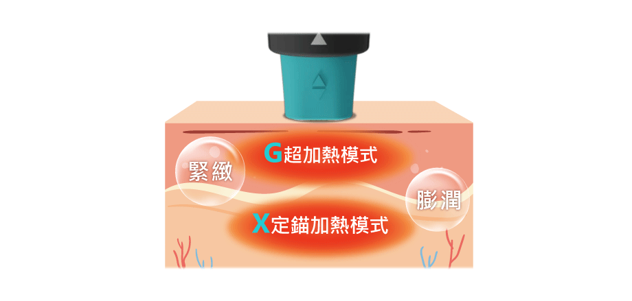 GXG超玩美模式治療過程插圖，設備圖示顯示治療步驟，圖中包含中文說明文字，背景為明亮診所環境，氛圍專業且安心，畫面傳達細緻關懷與科技感